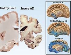 Image result for Brain Shrinking Disease Symptoms