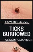 Image result for Remove Tick Under Skin