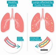 Image result for PICC Line Cystic Fibrosis
