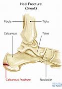 Image result for Broken Heel Foot