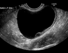 Image result for 25 Cm Ovarian Cyst