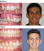 Image result for Overbite After Braces