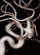 Image result for Cerebral Angiography Simulator