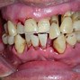 Image result for Gum Bone Loss