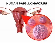 Image result for Internal Genital Human Papillomavirus