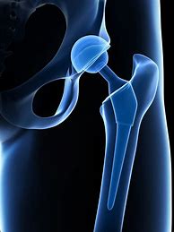 Image result for Hip-Replacement Symptoms Signs
