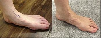 Image result for Collapsed Foot Arch Surgery