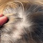 Image result for scalp psoriasis scabs
