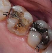 Image result for Broken Rotten Tooth