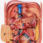 Image result for Small Intestine Hernia