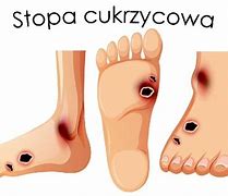 Image result for co_to_znaczy_zespół_ręka stopa