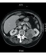 Image result for How Big Is 7 Cm Tumor