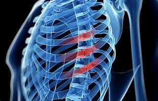 Image result for Signs of Broken Ribs
