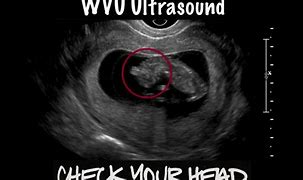 Image result for Anencephaly Ultrasound