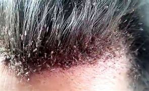 Image result for What Does Bad Lice Look Like