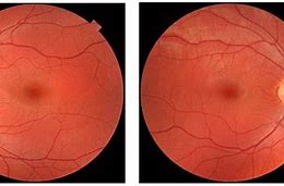 Image result for Normal Retina Right and Left Eye
