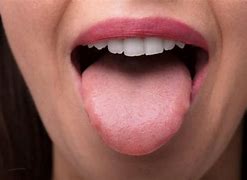 Image result for Bump/Blister Side of Tongue Papilloma
