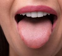 Image result for HPV On Back of Tongue
