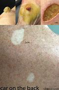 Image result for Cautery Skin Cancer