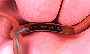 Image result for Acute Ischemic Stroke