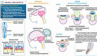 Image result for Cranial Neural Tube Defects