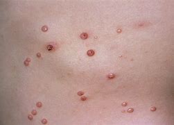 Image result for Molluscum Warts On Back of Knee