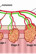Image result for Colon Cancer Final Stage