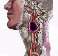 Image result for chemodectoma