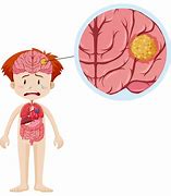 Image result for Crazy Brain Tumor Cartoon