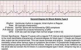 Image result for Mobitz Type 2 EKG Strip