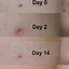 Image result for Moles On Skin Removal