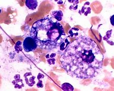 Image result for Atypical Mononuclear Cells