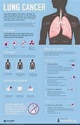 Image result for Most Common Lung Cancer