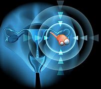 Image result for 4 Cm Cyst On Ovary