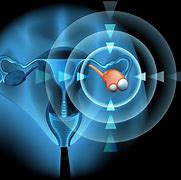 Image result for 2.7 Cm Cyst On Ovary