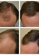 Image result for Minoxidil Results Women