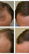 Image result for Minoxidil Before and After