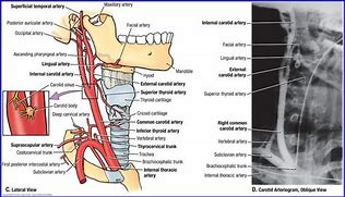 Image result for What Is the Carotid Bulb