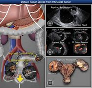 Image result for Large Benign Ovarian Tumors