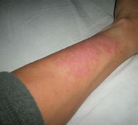 Image result for Allergic Reaction On Arms
