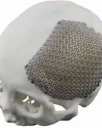 Image result for Metal Brain Implant