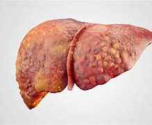 Image result for liver cirrhosis
