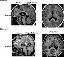 Image result for Alobar Holoprosencephaly MRI