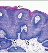 Image result for Genital Condyloma