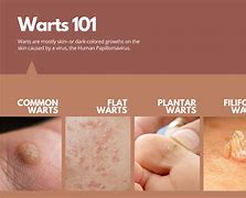 Image result for Common Type of Warts