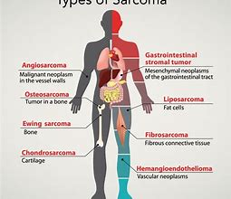 Image result for Sarcoma Pictures