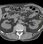 Image result for Bosniak 2 Renal Cyst