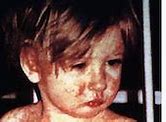Image result for Black Measles Grape