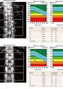 Image result for Bone Mineral Density Osteoporosis