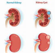 Image result for Burst Kidney Cyst